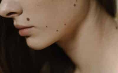 Peut-on enlever les grains de beauté naturellement sans danger ?